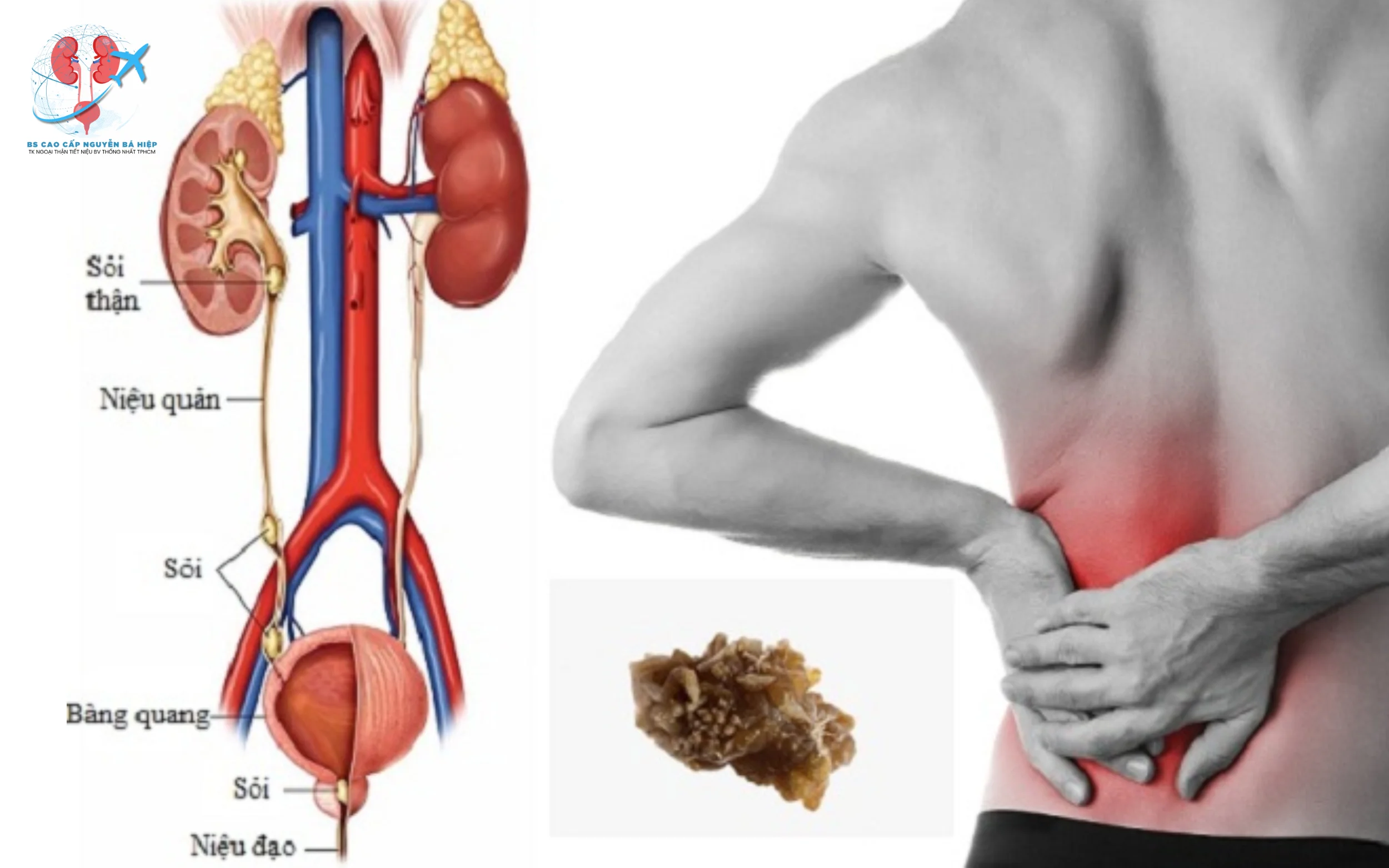 Mổ hở lấy sỏi thận là phương pháp phẫu thuật được chỉ định trong các trường hợp sỏi thận kích thước lớn